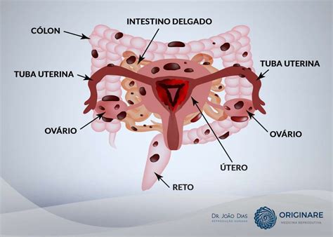 por onde sai a menstruação